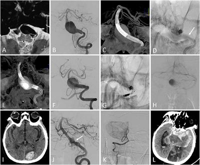 Flow Diversion vs. Stent-Assisted Coiling in the Treatment of Intradural Large Vertebrobasilar Artery Aneurysms